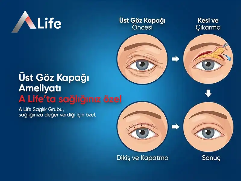 Üst Göz Kapağı Ameliyatı
